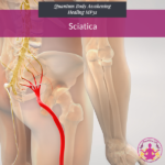 Sciatica