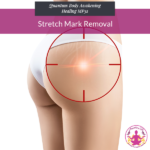 Stretch Mark Removal